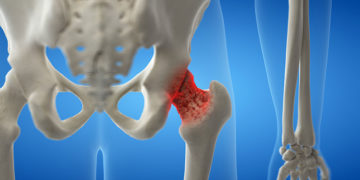 Physical Therapy Guide to Osteoporosis